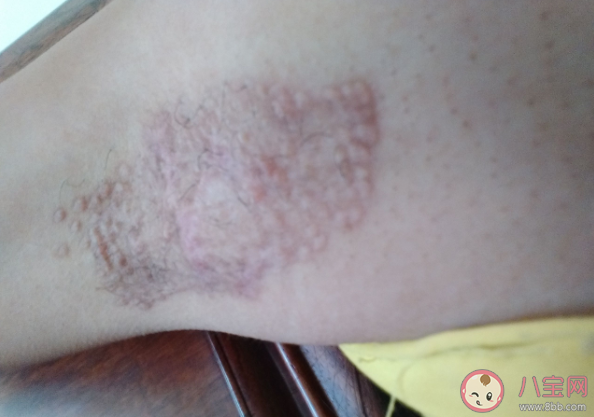 哪些癥狀可能是疤痕癌變 如何預(yù)防疤痕癌變