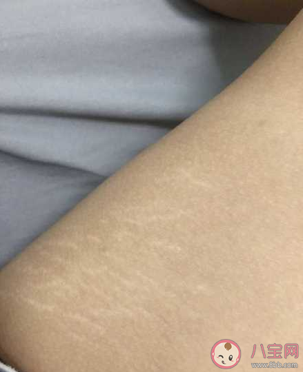 肥胖紋會(huì)自己好嗎 肥胖紋是因?yàn)殚L(zhǎng)得太胖了嗎