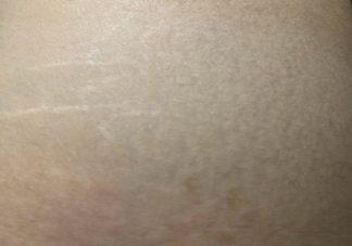 肥胖紋會(huì)自己好嗎 肥胖紋是因?yàn)殚L得太胖了嗎