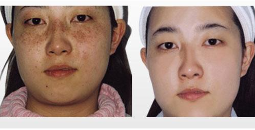 激光祛斑和皮秒祛斑哪個更好 激光祛斑和皮秒祛斑區別是什么