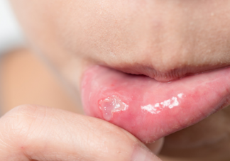 為什么不小心咬破嘴就口腔潰瘍了 口腔潰瘍怎么愈合快