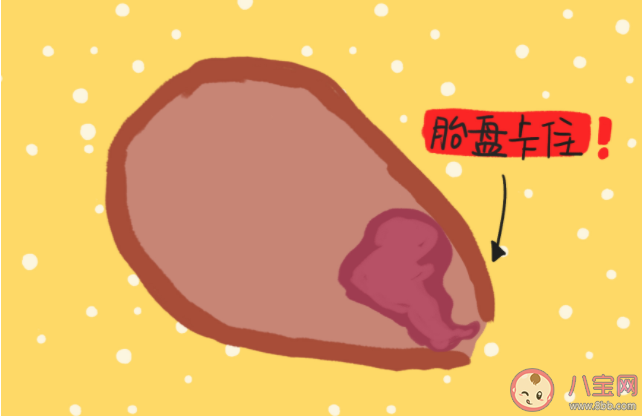 產(chǎn)婦出現(xiàn)什么情況需要經(jīng)歷手剝胎盤 如何預防胎盤滯留發(fā)生