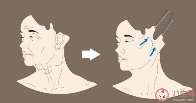 拉皮的最佳年齡是多少歲 拉皮手術后疤痕會很明顯嗎
