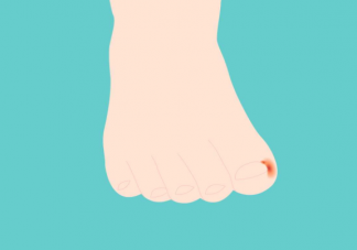 指甲太短容易得甲溝炎嗎 甲溝炎有什么辦法好轉