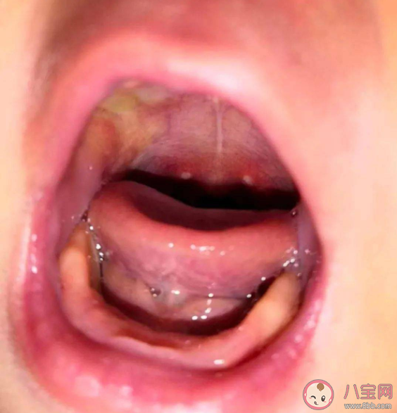 皰疹性咽峽炎幾歲孩子最常見 皰疹性咽峽炎怎么對癥護理