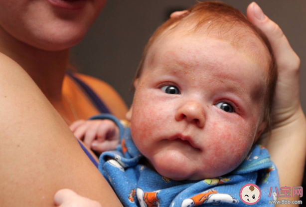 孩子洗澡水里滴去痱水有用嗎 夏天怎么預防寶寶起痱子