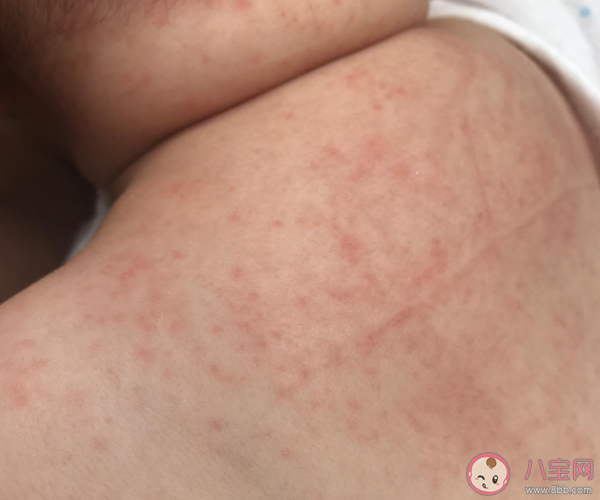 孩子洗澡水里滴去痱水有用嗎 夏天怎么預防寶寶起痱子