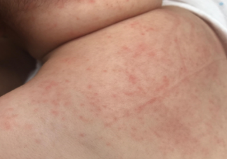 孩子洗澡水里滴去痱水有用嗎 夏天怎么預防寶寶起痱子