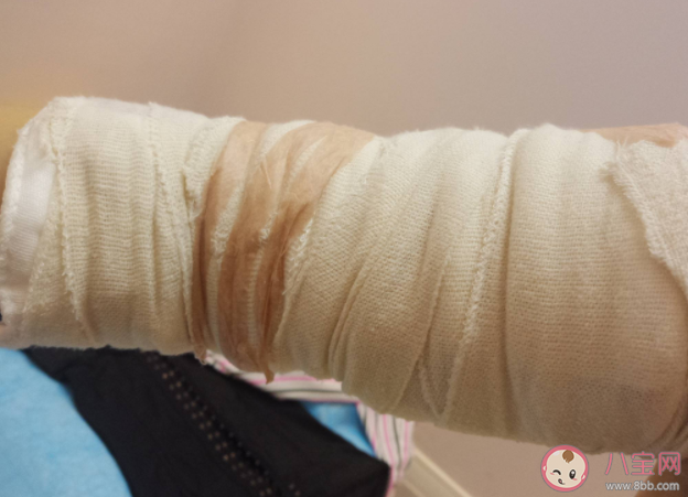 抽脂手術有什么風險 壞死性筋膜炎有多危險