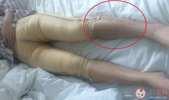 抽脂手術有什么風險 壞死性筋膜炎有多危險