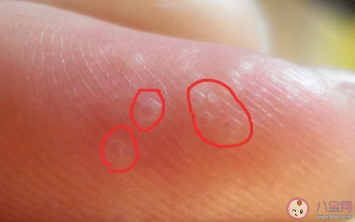 一到夏天就長的小水泡是什么 患上汗皰疹怎么辦