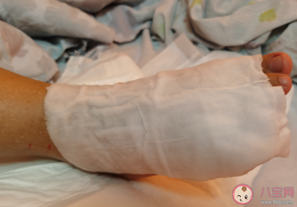 被毒蟲咬傷有什么表現(xiàn)癥狀 夏季被毒蟲咬傷怎么處理急救