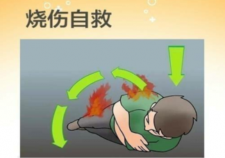 醫(yī)生科普燒傷后如何自救 應(yīng)對燒燙傷的五個(gè)規(guī)定動作