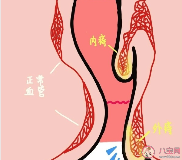 痔瘡疼痛出血怎么辦 痔瘡什么時候必須手術