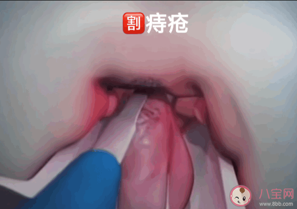 痔瘡疼痛出血怎么辦 痔瘡什么時候必須手術