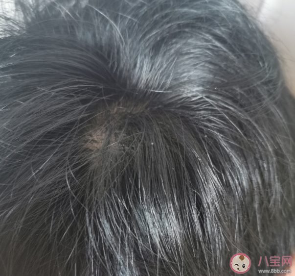 Selsun去屑洗發水的效果好嗎 Selsun去屑洗發水好不好用