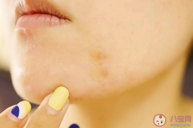 痘痘貼對痘痘有效果嗎 痘痘貼的適合什么人群 痘痘貼對痘痘有效果嗎 痘痘貼的適合什么人群