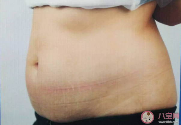 吸脂以后會不會導(dǎo)致皮膚松弛下垂 哪些部位可以吸脂