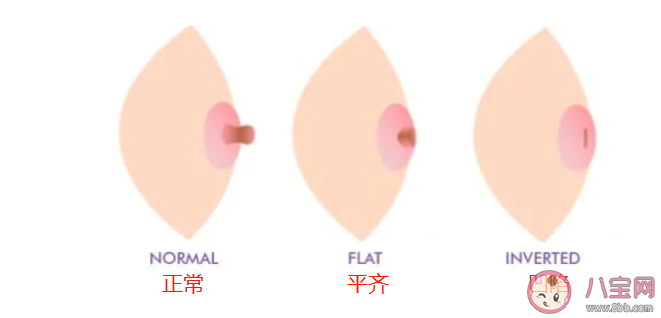怎樣的乳頭算內(nèi)陷 怎么判斷乳頭內(nèi)陷的嚴重程度