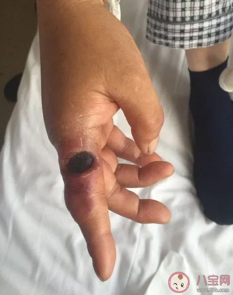 炭疽是什么疾病 感染炭疽病后都有哪些癥狀