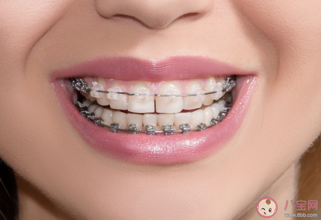 為什么牙齒矯正后會反彈 如何避免矯正后反彈