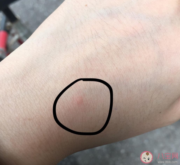 螞蟻莊園蚊子叮的包越大說明毒性越強這種說法正確嗎 8月25日正確答案 螞蟻莊園蚊子叮的包越大說明毒性越強這種說法正確嗎 8月25日正確答案