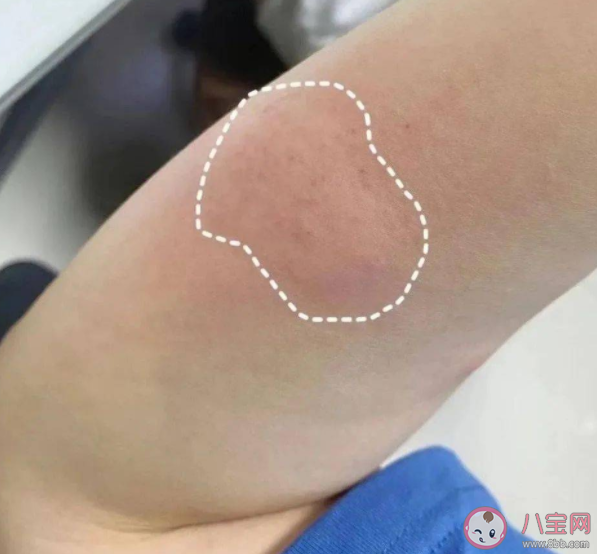 螞蟻莊園蚊子叮的包越大說明毒性越強這種說法正確嗎 8月25日正確答案 螞蟻莊園蚊子叮的包越大說明毒性越強這種說法正確嗎 8月25日正確答案