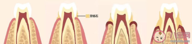 長期不刷牙會引發肺炎嗎 刷牙最重要的是刷哪里