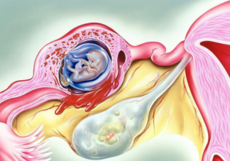 試管嬰兒也會宮外孕嗎 試管嬰兒能避免宮外孕嗎