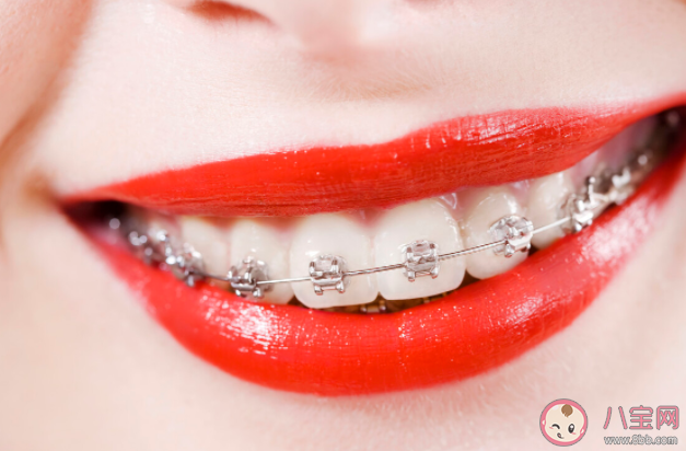 為什么戴牙套很久還是沒變化 戴牙套需不需要忌口 為什么戴牙套很久還是沒變化 戴牙套需不需要忌口