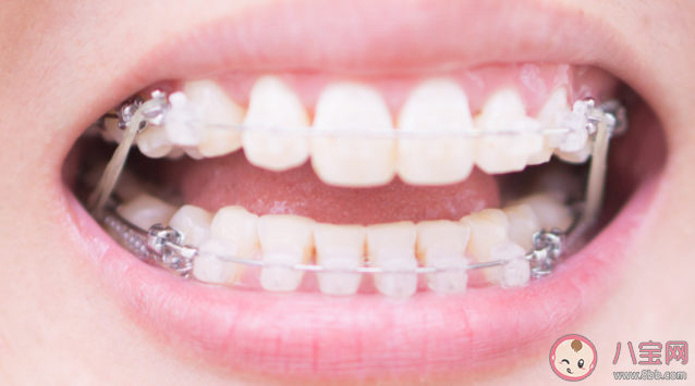 為什么戴牙套很久還是沒變化 戴牙套需不需要忌口 為什么戴牙套很久還是沒變化 戴牙套需不需要忌口