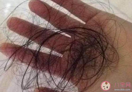 為什么年紀輕輕就脫發 怎樣防止脫發 為什么年紀輕輕就脫發 怎樣防止脫發