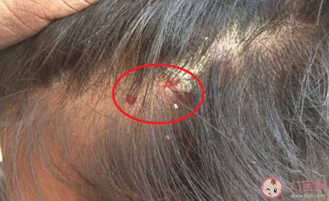 頭皮上摳下的小顆粒是什么 如何正確護(hù)理頭皮