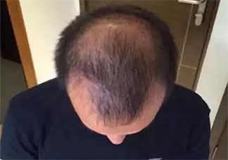 為什么年紀輕輕就脫發 怎樣防止脫發