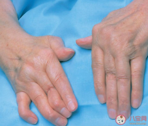 關節炎是凍出來的嗎 風濕性關節炎怎么預防