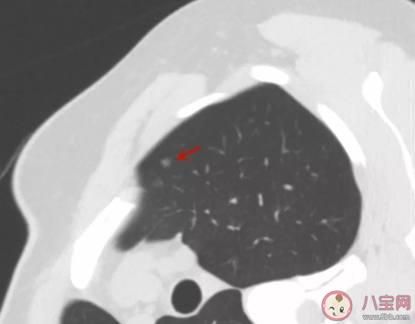 肺結(jié)節(jié)和肺癌有什么關(guān)系 為什么發(fā)現(xiàn)肺結(jié)節(jié)的人越來越多 肺結(jié)節(jié)和肺癌有什么關(guān)系 為什么發(fā)現(xiàn)肺結(jié)節(jié)的人越來越多