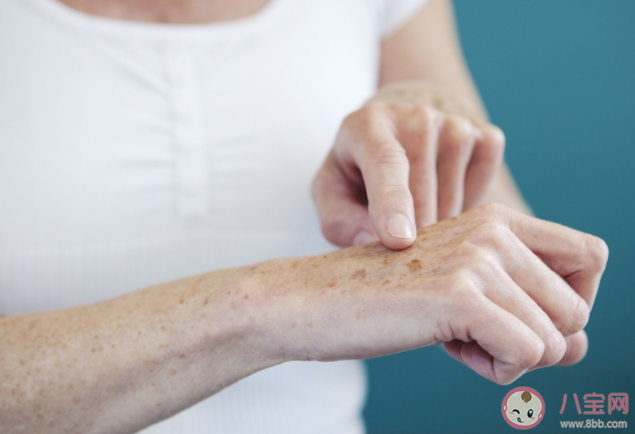 老年斑多大年紀(jì)的人長(zhǎng)算正常 如何改善長(zhǎng)斑的問(wèn)題 老年斑多大年紀(jì)的人長(zhǎng)算正常 如何改善長(zhǎng)斑的問(wèn)題