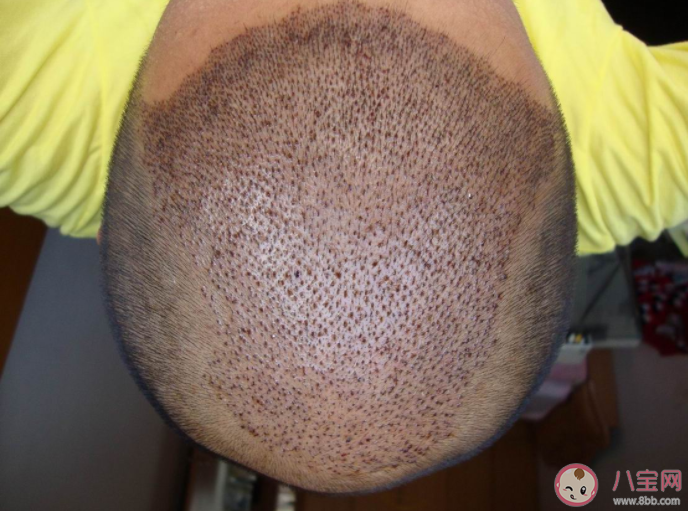 想要植發需要滿足哪些條件 植發手術前要注意的事項 想要植發需要滿足哪些條件 植發手術前要注意的事項