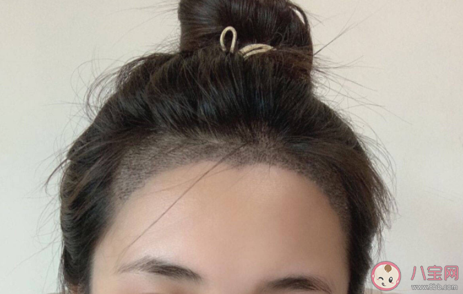 想要植發需要滿足哪些條件 植發手術前要注意的事項 想要植發需要滿足哪些條件 植發手術前要注意的事項