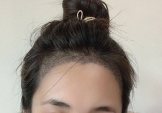 想要植發(fā)需要滿足哪些條件 植發(fā)手術前要注意的事項