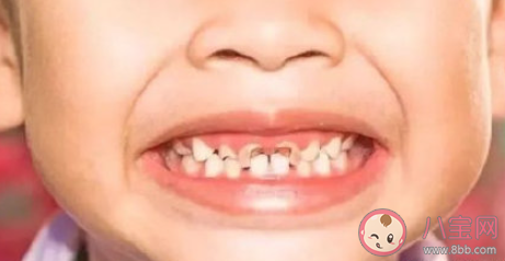 蛀牙真的和吃糖有關(guān)嗎 如何防止蛀牙