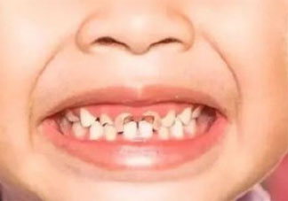 蛀牙真的和吃糖有關嗎 如何防止蛀牙