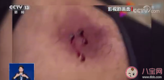 被蛇咬可以用嘴吸出毒液嗎 被蛇咬等待救治期間可以做什么