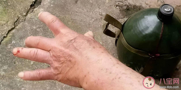 被蛇咬可以用嘴吸出毒液嗎 被蛇咬等待救治期間可以做什么