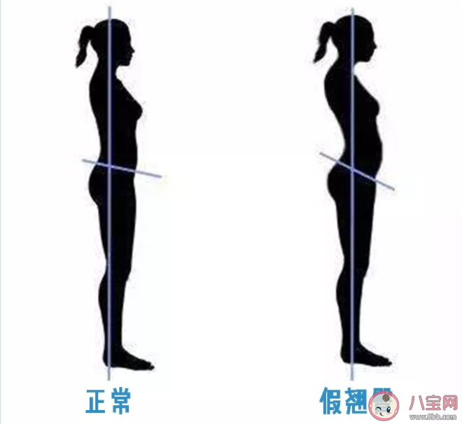 屁股真的越翹越好嗎 如何矯正骨盆前傾