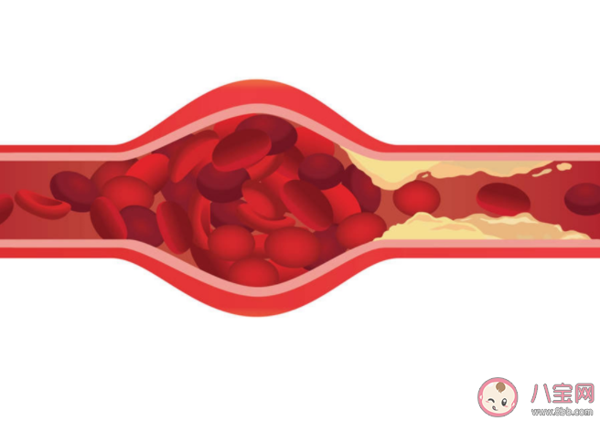血液粘稠高有什么癥狀信號 血液粘稠怎么調(diào)理