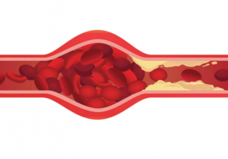 血液粘稠高有什么癥狀信號 血液粘稠怎么調理