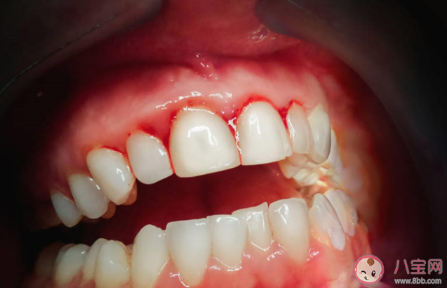 消腫鎮痛止血的牙膏真的有效果嗎 牙齦出血該怎么辦