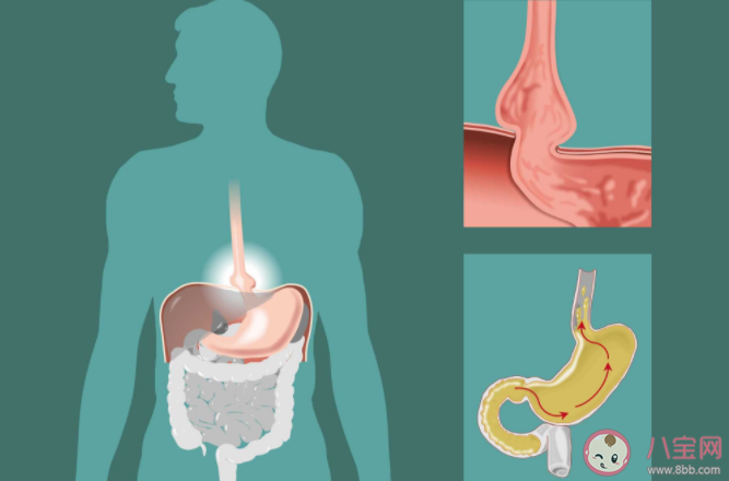 胃食管反流病為什么一停藥就復發 如何預防胃食管反流復發