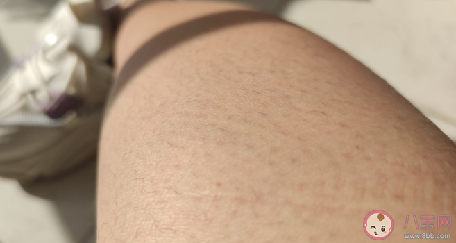 雞皮膚可以根治嗎 雞皮膚如何護理改善